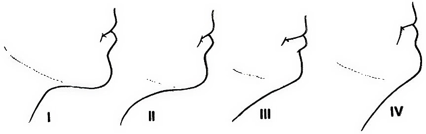 Profile sketches showing different jaw angles.
