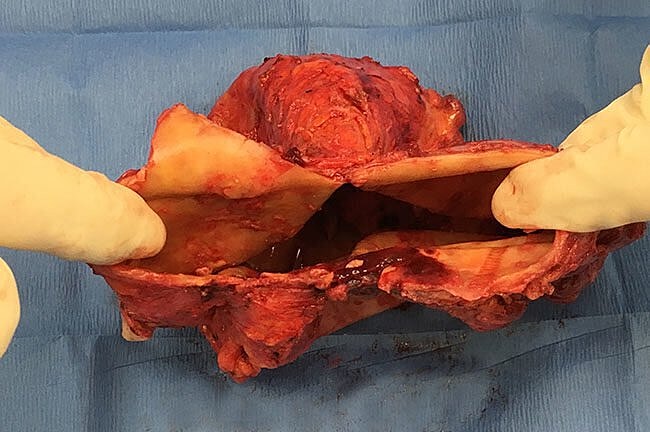 Surgical procedure showing internal body structure.