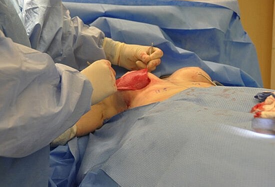 Surgical procedure in a sterile environment.