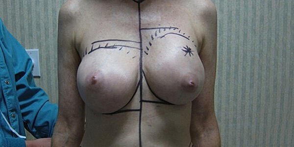 Pre-surgery markings on patient's torso.