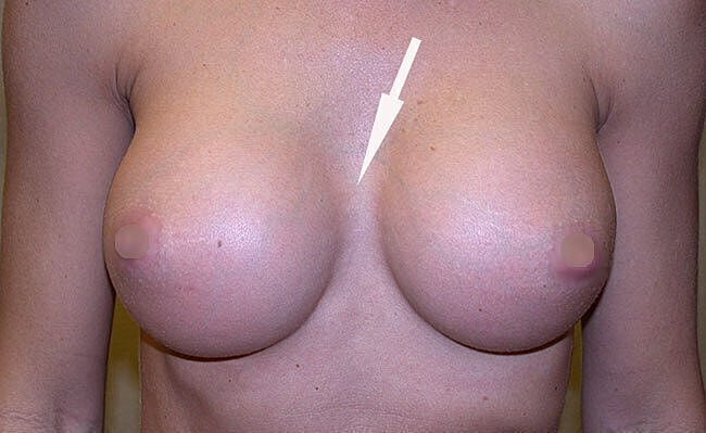 Breast anatomy with labeled features.