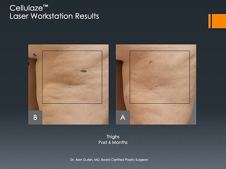 Cellulaze laser treatment results after six months
