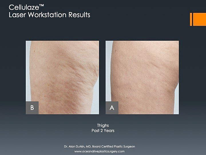 Cellulaze laser treatment results on thighs.