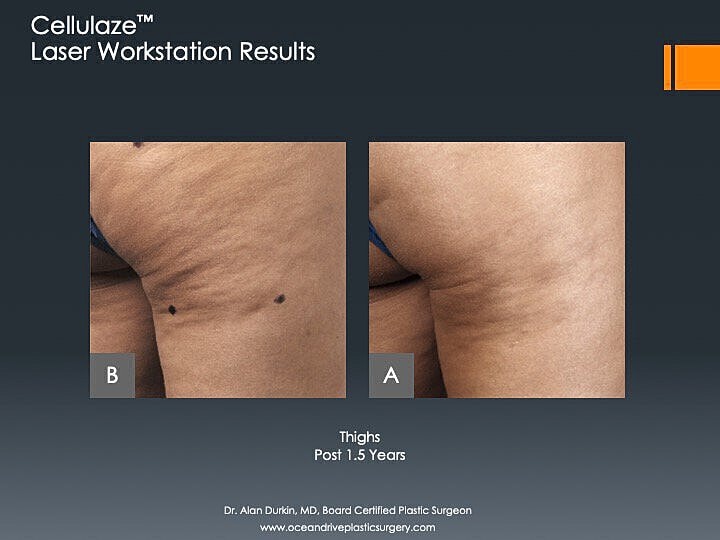 Thigh appearance before and after laser treatment.