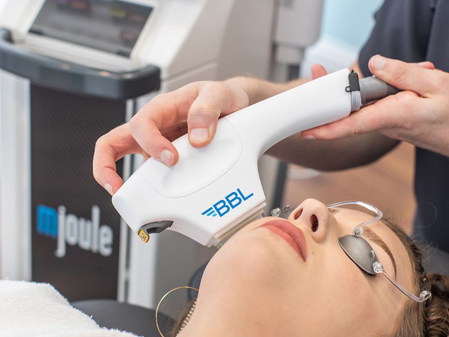 BBL treatment for skin rejuvenation in progress.