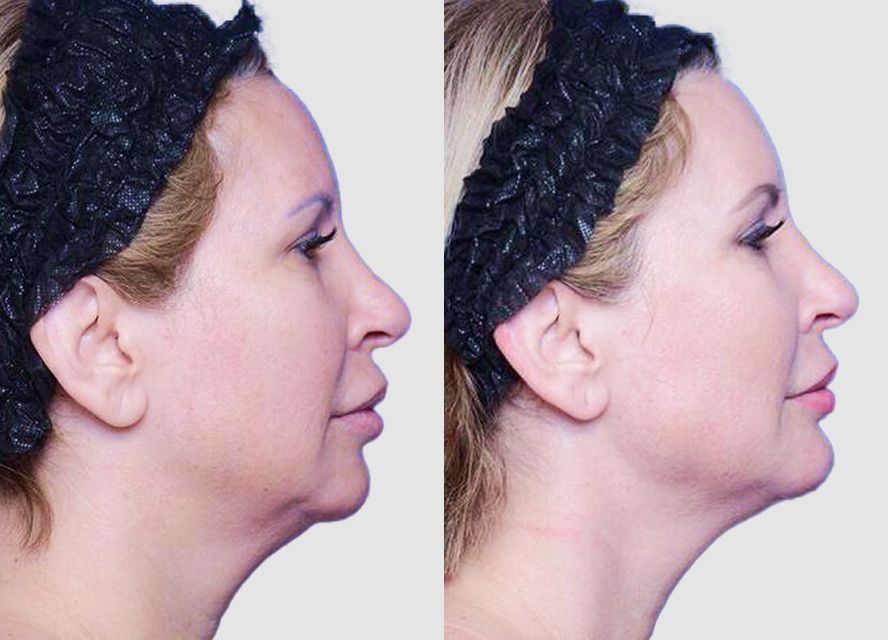 Before and after profile facial transformation.