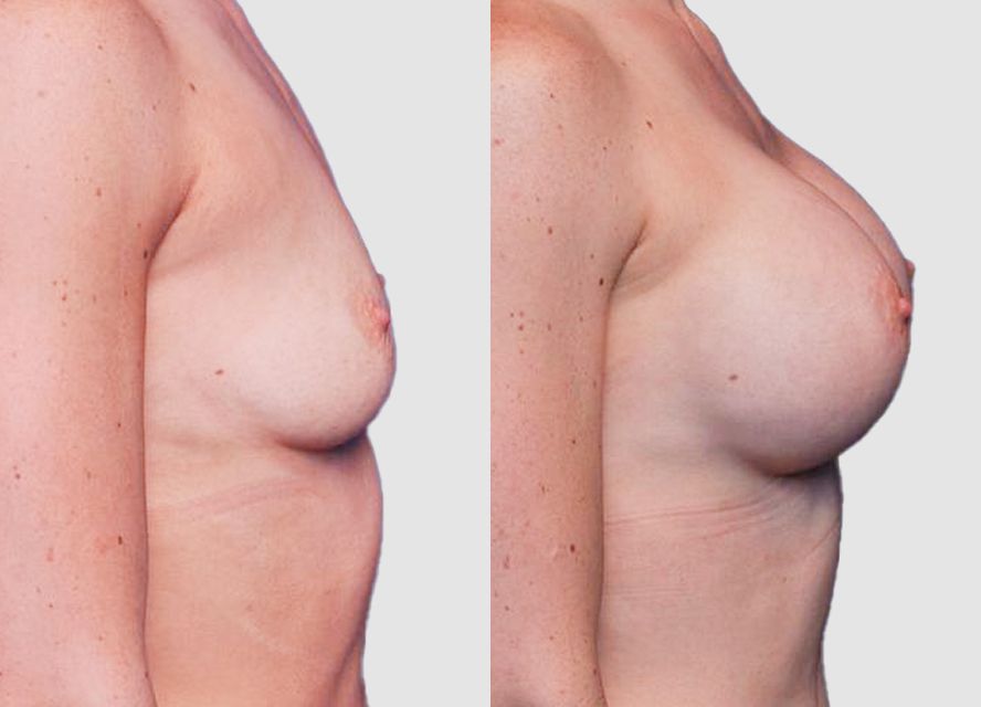 Before and after breast augmentation comparison side view.