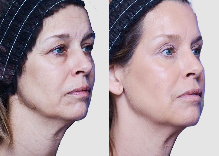 Before and after facial rejuvenation treatment comparison.