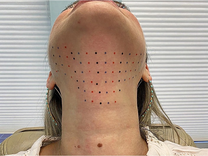 Skin markings on a woman's neck for treatment.