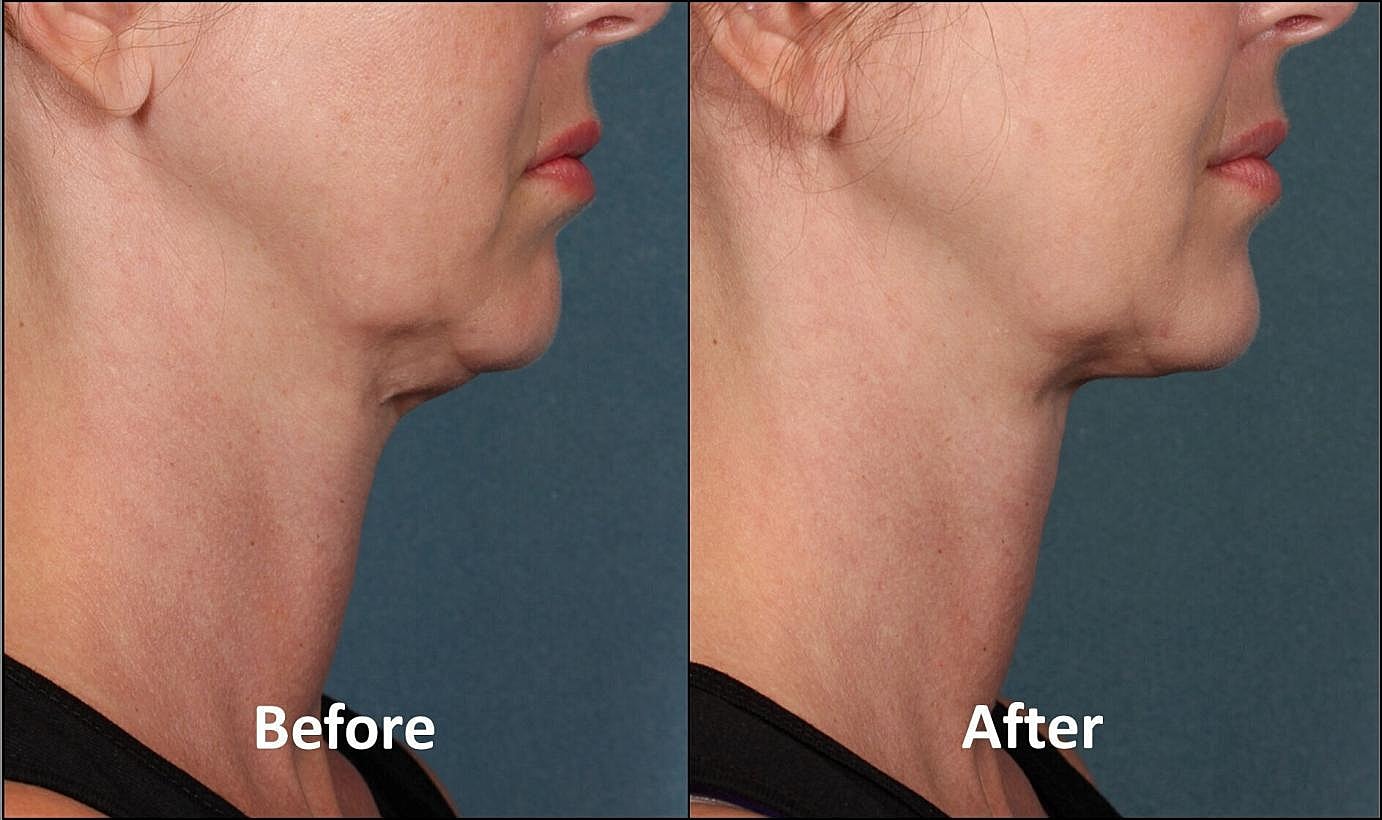 Before and after neck treatment comparison.