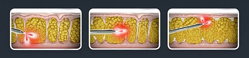 Medical procedure illustrating targeted tissue treatment.