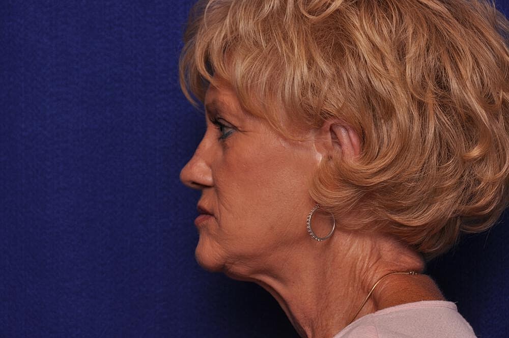 Renuva Before & After