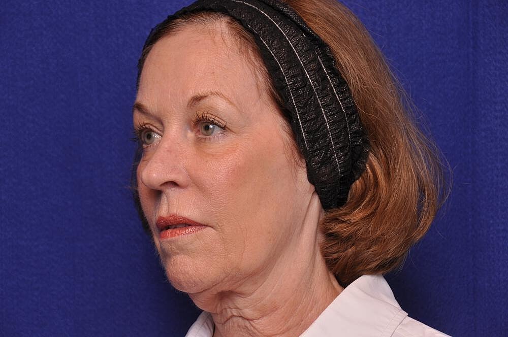 Renuva Before & After