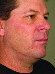 Ultherapy Before & After