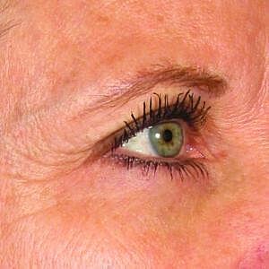 Ultherapy Before & After