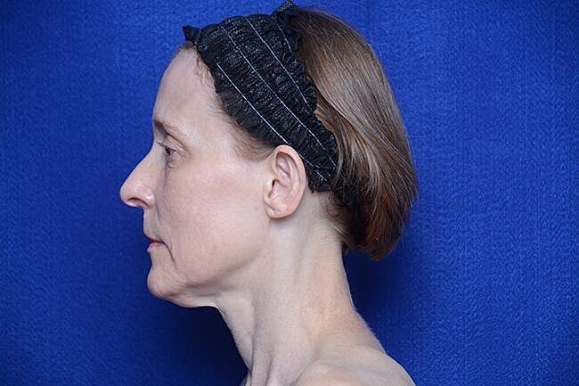 Brow Lift Before & After