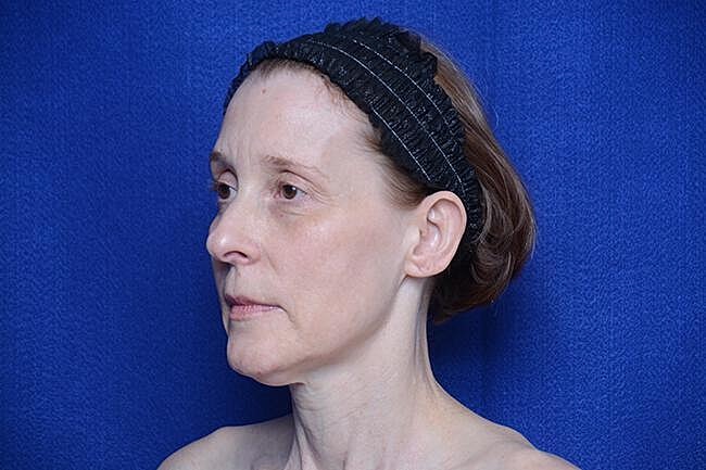 Brow Lift Before & After