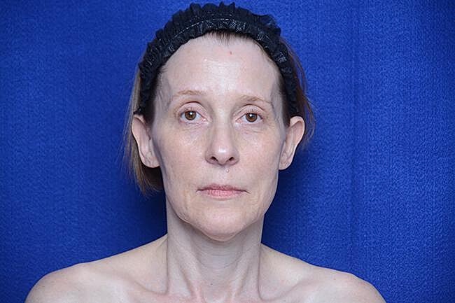 Brow Lift Before & After