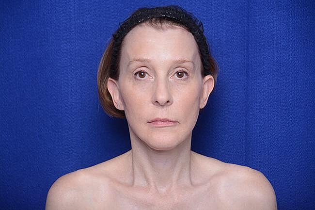 Brow Lift Before & After