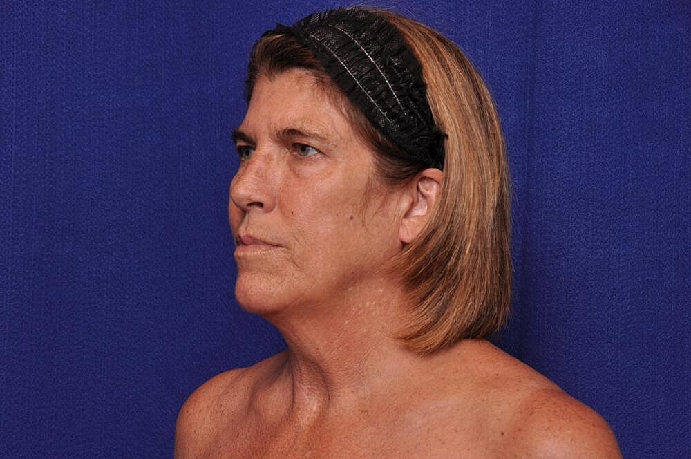 Brow Lift Before & After