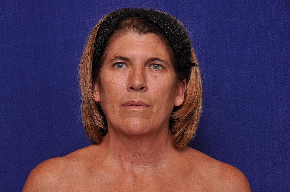 Brow Lift Before & After