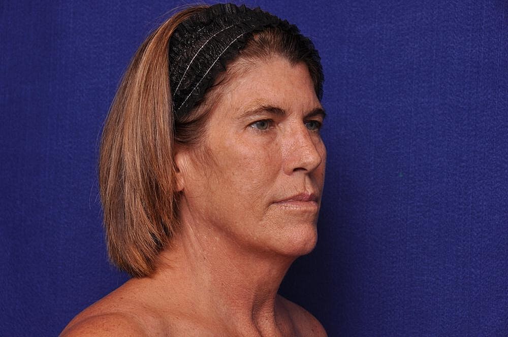 Brow Lift Before & After