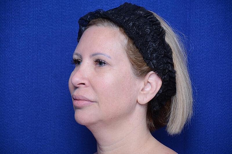 Chin Implant Before & After