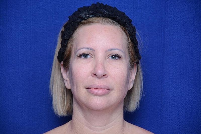 Chin Implant Before & After