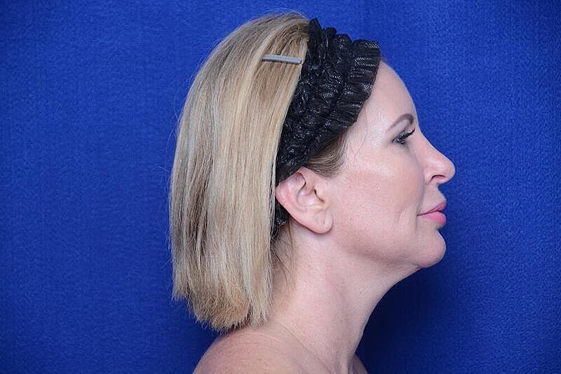 Chin Implant Before & After