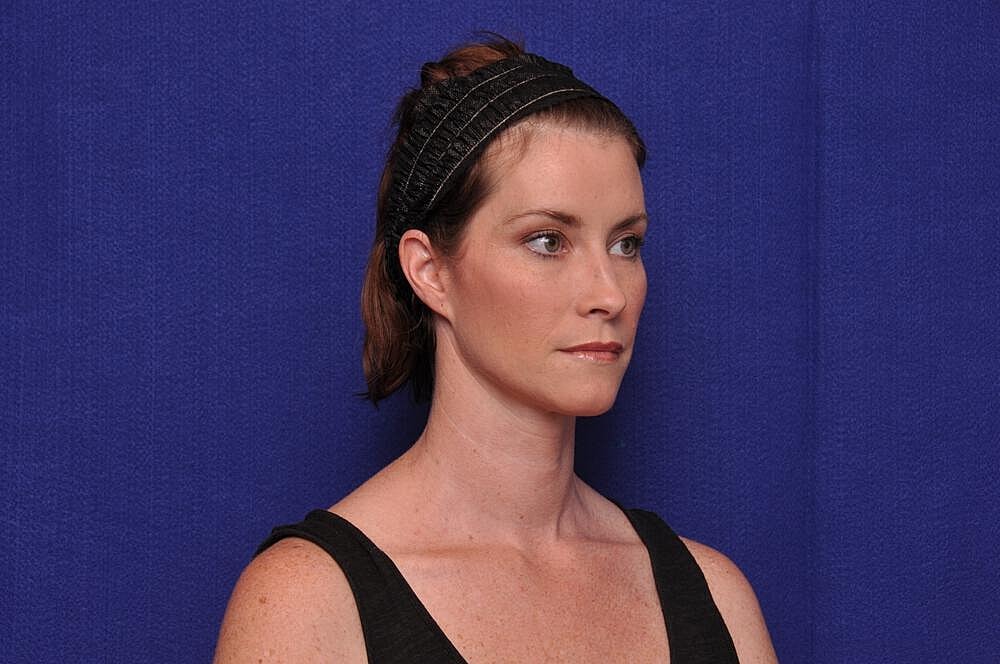 Liquid Facelift Before & After