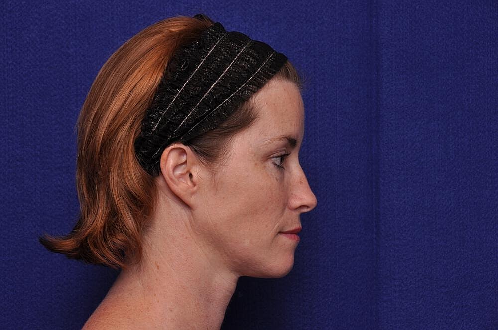 Liquid Facelift Before & After