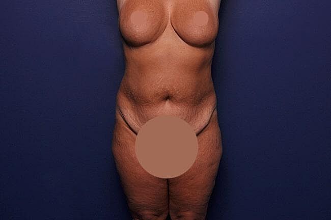Body Lift Before & After