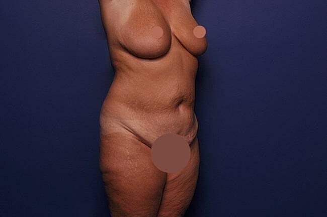 Body Lift Before & After