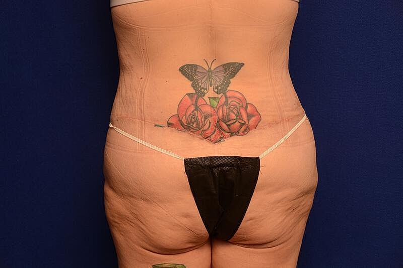 Body Lift Before & After