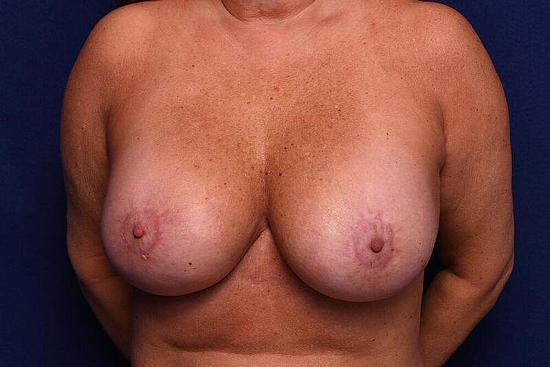 Breast Revision Before & After
