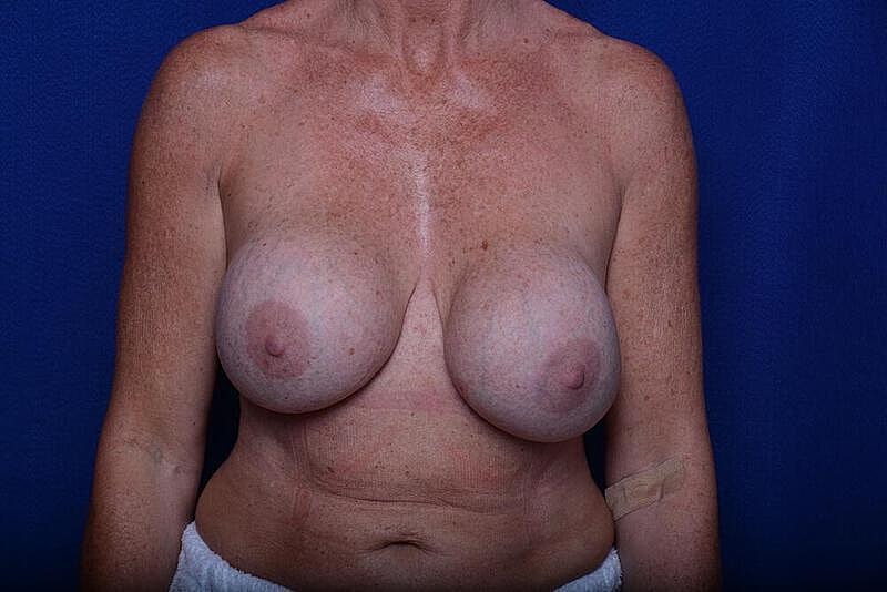 Breast Revision Before & After
