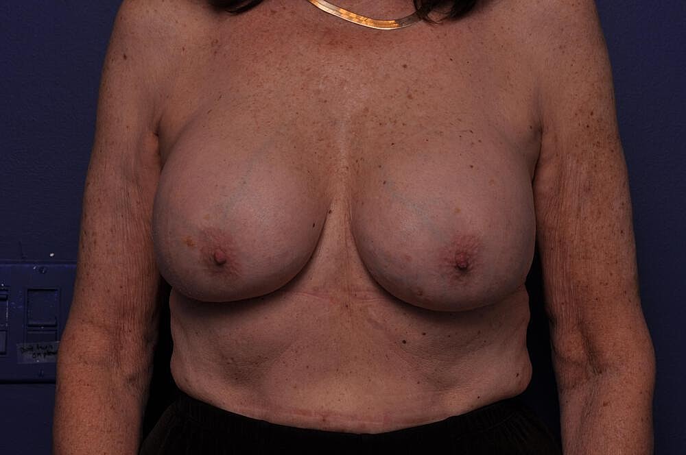 Breast Revision Before & After
