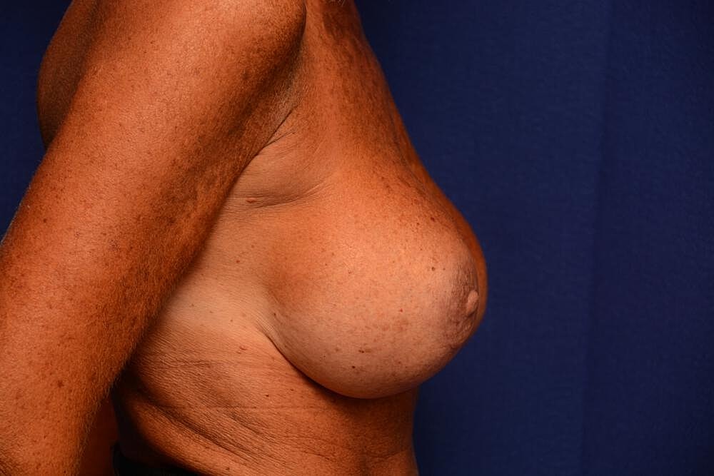 Breast Revision Before & After