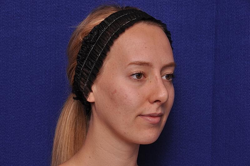 Rhinoplasty Before & After