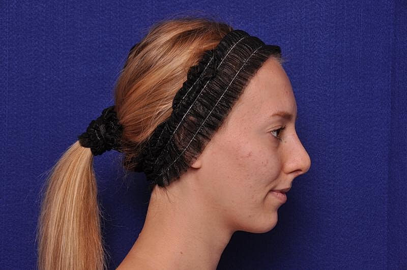 Rhinoplasty Before & After