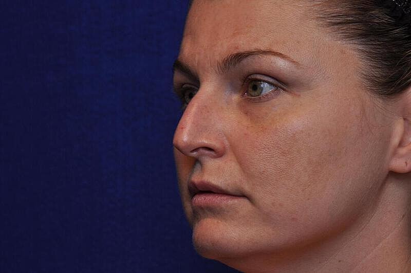 Rhinoplasty Before & After