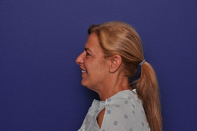 Rhinoplasty Before & After