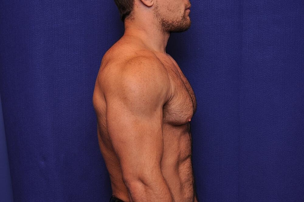 Athletic Gynecomastia Surgery Before & After