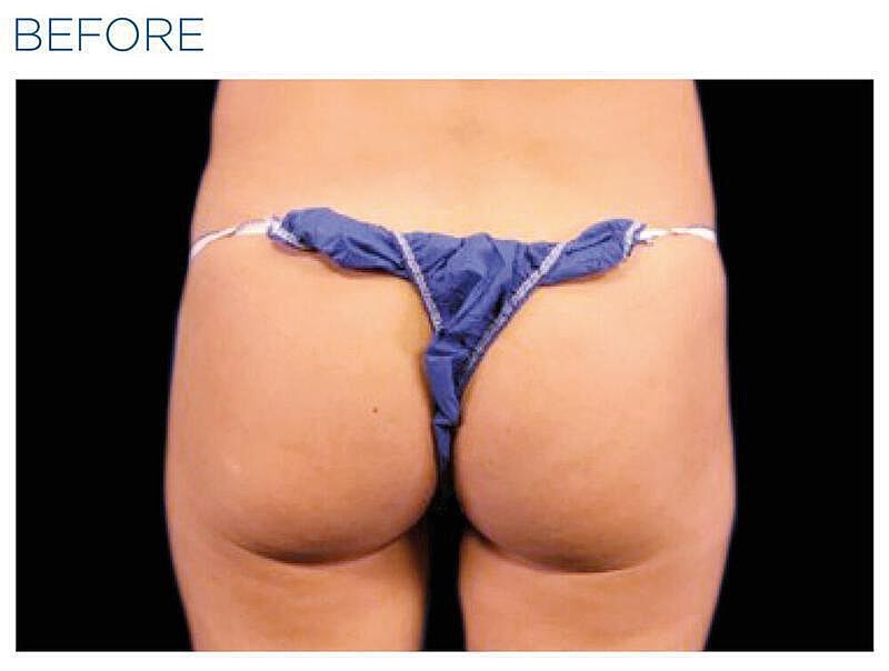 Emsculpt Gluteal Before & After