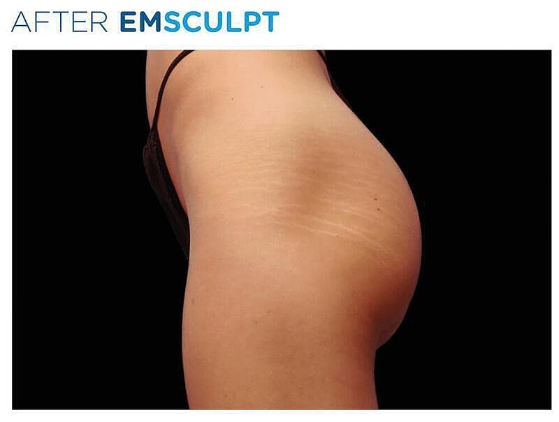 Emsculpt Gluteal Before & After