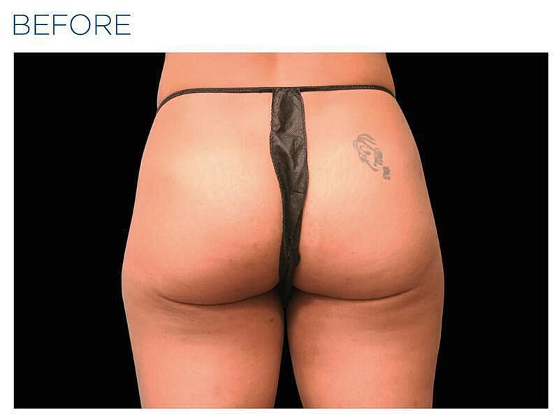 Emsculpt Gluteal Before & After