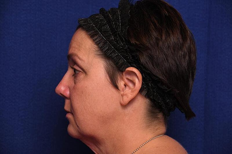 Facelift Before & After