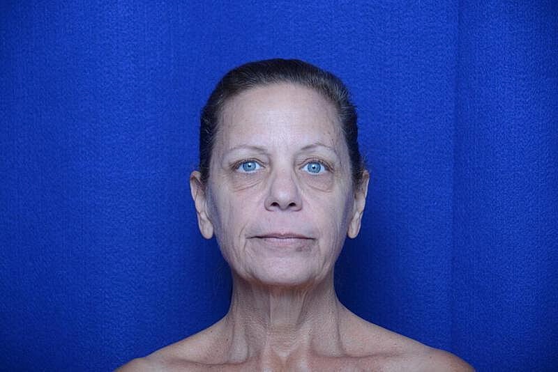 Facelift Before & After