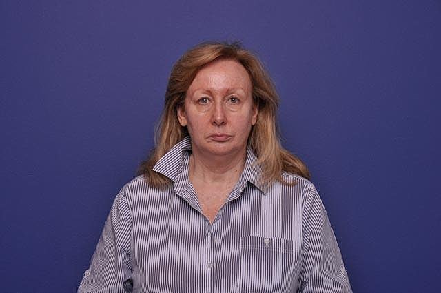 Facelift Before & After