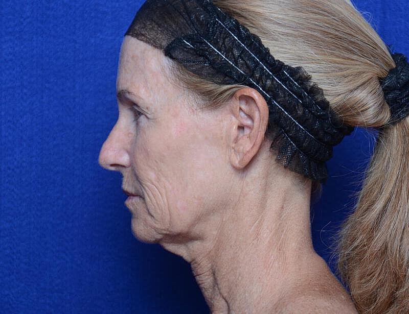 Facelift Before & After